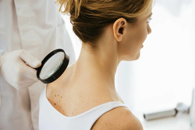 cropped view of dermatologist holding magnifying glass while examining woman with melanoma