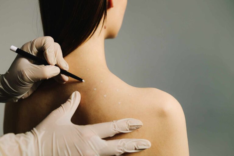 Migraine therapy skin marking for headache relief. Doctor applies precise marks on patient back